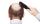 Uomo con alopecia areata