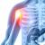Protesi anatomica e inversa per l'artrosi di spalla
