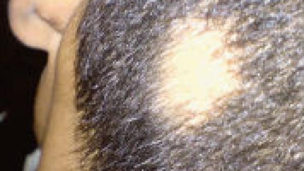 Che cosa è un'alopecia areata?