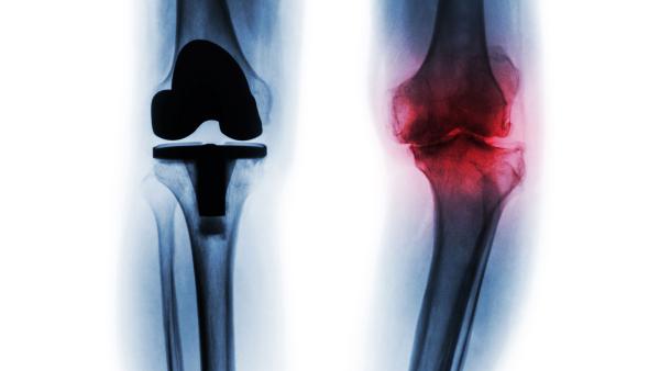 protesi di ginocchio 3d